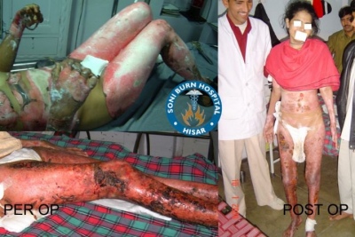 soni-burn-hospital-5