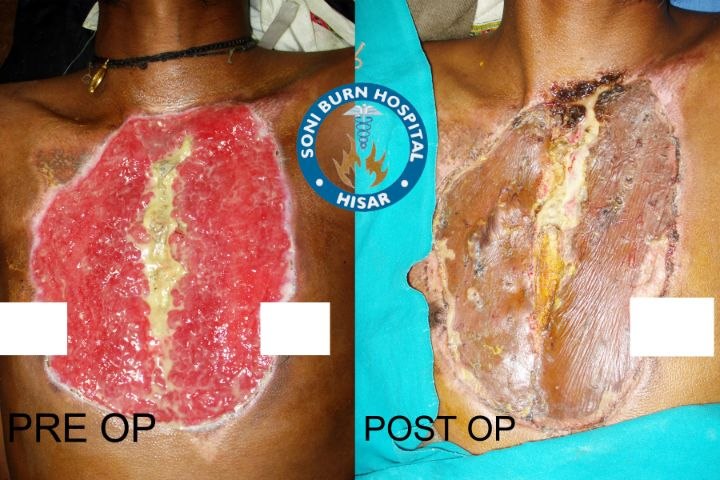 soni-burn-hospital-10