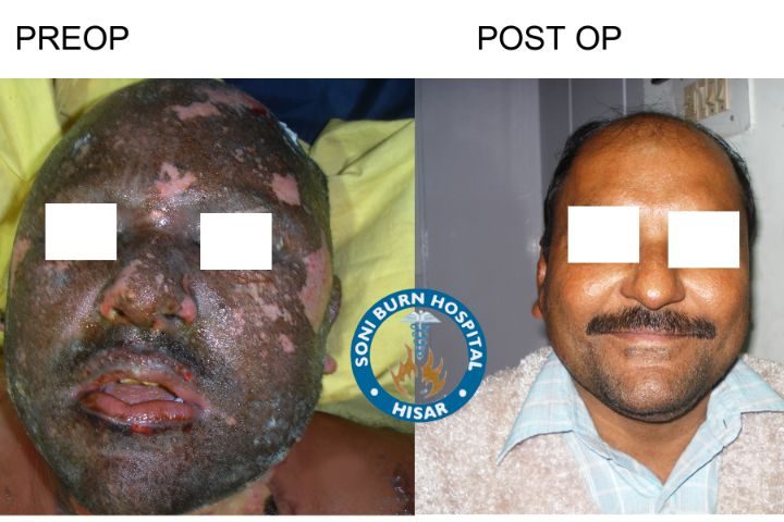 soni-burn-hospital-3