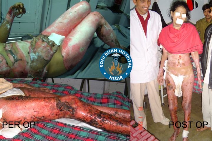 soni-burn-hospital-5