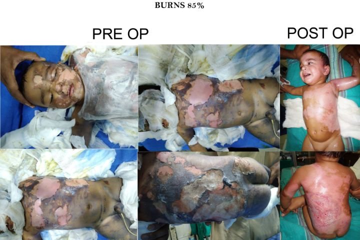 soni-burn-hospital-7